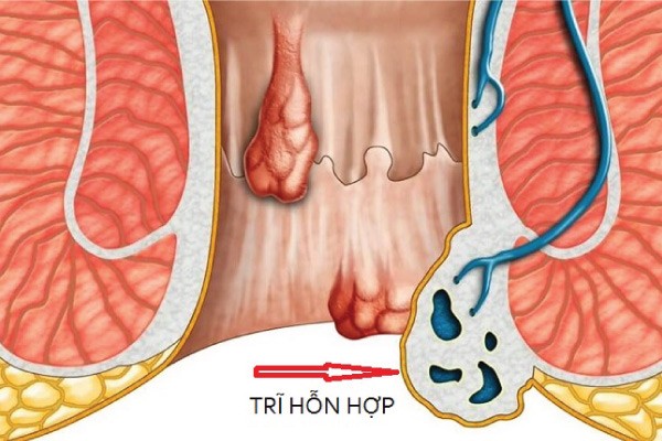 bài thuốc đông y chữa trĩ