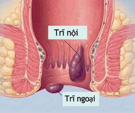 bệnh trĩ nội ngoại