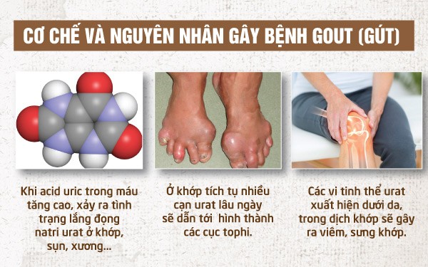Nguyên nhân của bệnh Gout