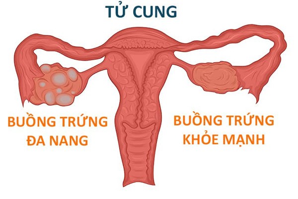 Chữa buồng trứng đâ nang bằng đông Y được nhiều người lựa chọn