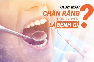 Chay Mau Chan Rang La Banh Gi