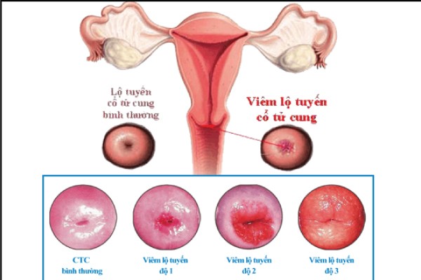 bài thuốc đông y chữa viêm lộ tuyến cổ tử cung