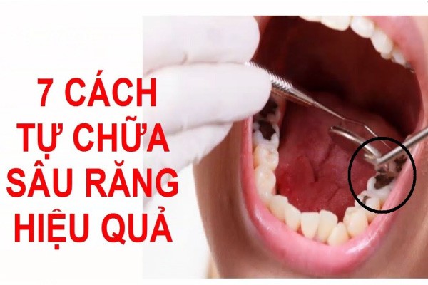 bài thuốc đông y chữa sâu răng