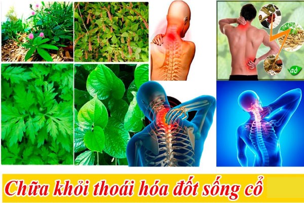 bài thuốc đông y chữa thoái hóa đốt sống cổ