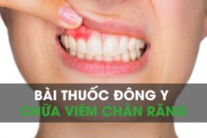 bài thuốc đông y chữa viêm chân răng