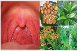 Bài thuốc đong y chữa viêm họng
