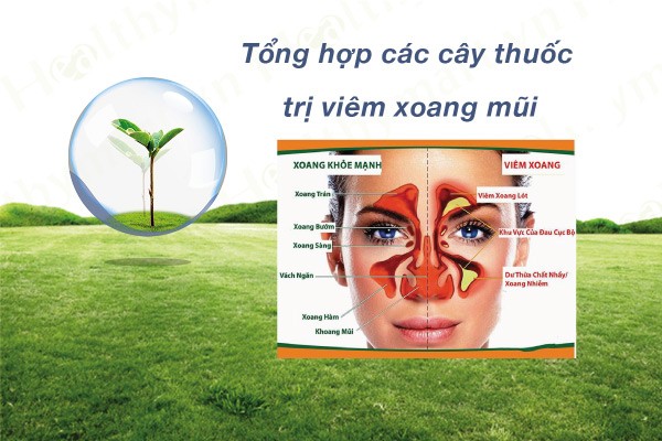 bài thuốc đông y chữa viêm xoang mũi