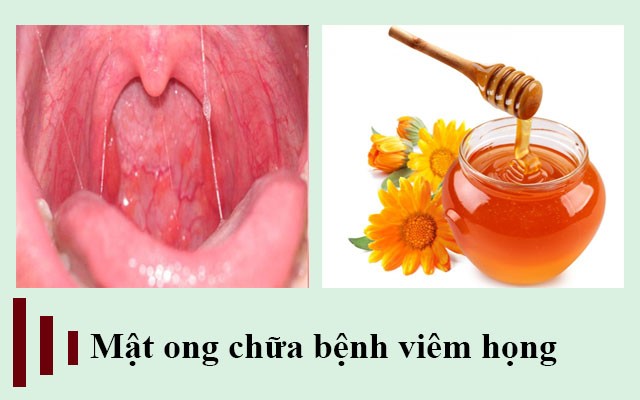 Bài thuốc chữa viêm họng mãn tính bằng mật ong